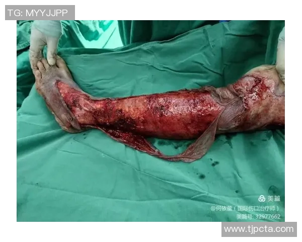 莱万遭遇重伤左大腿肌肉撕裂预计缺阵四到六周 莱万遭遇重伤左大腿肌肉撕裂预计缺阵四到六周